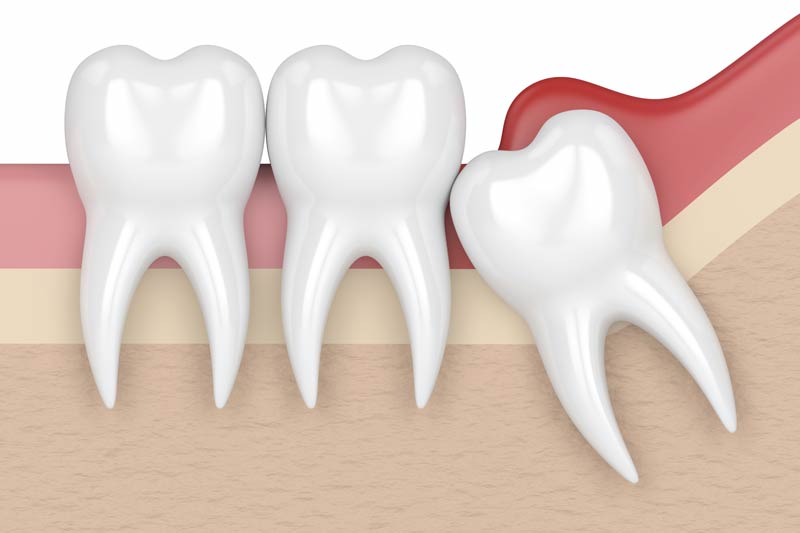 Wisdom Tooth Removal in Woodland Hills